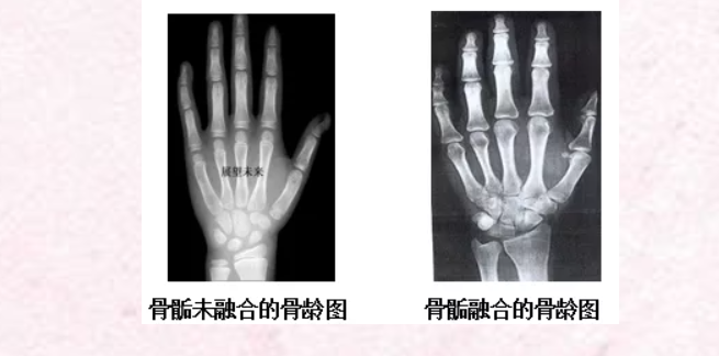 【公益义诊】免费测骨龄--关注身高，助力成长